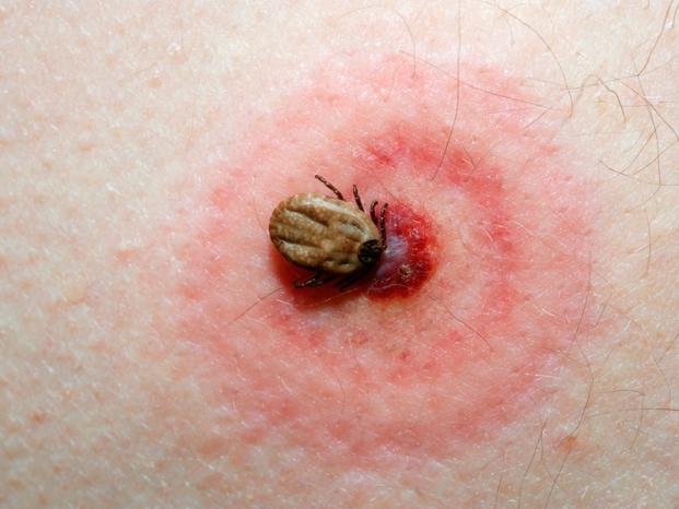 Lyme Borreliose Ausschlag im Gesicht